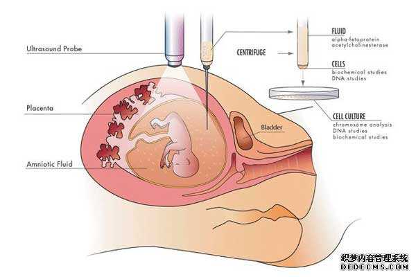 试管前需要_三代试管婴儿流程图_宫腔积液如何影响辅助生殖技术中助孕过程？